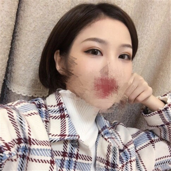 温州和平陈炳伟双眼皮怎么样?价格案例
