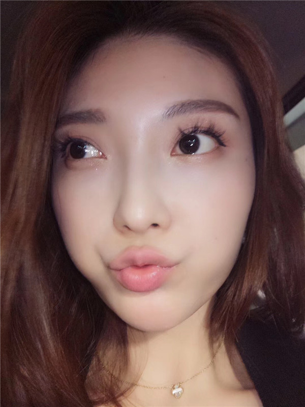 哈尔滨韩美于兆松去黑眼圈怎么样?价格案例