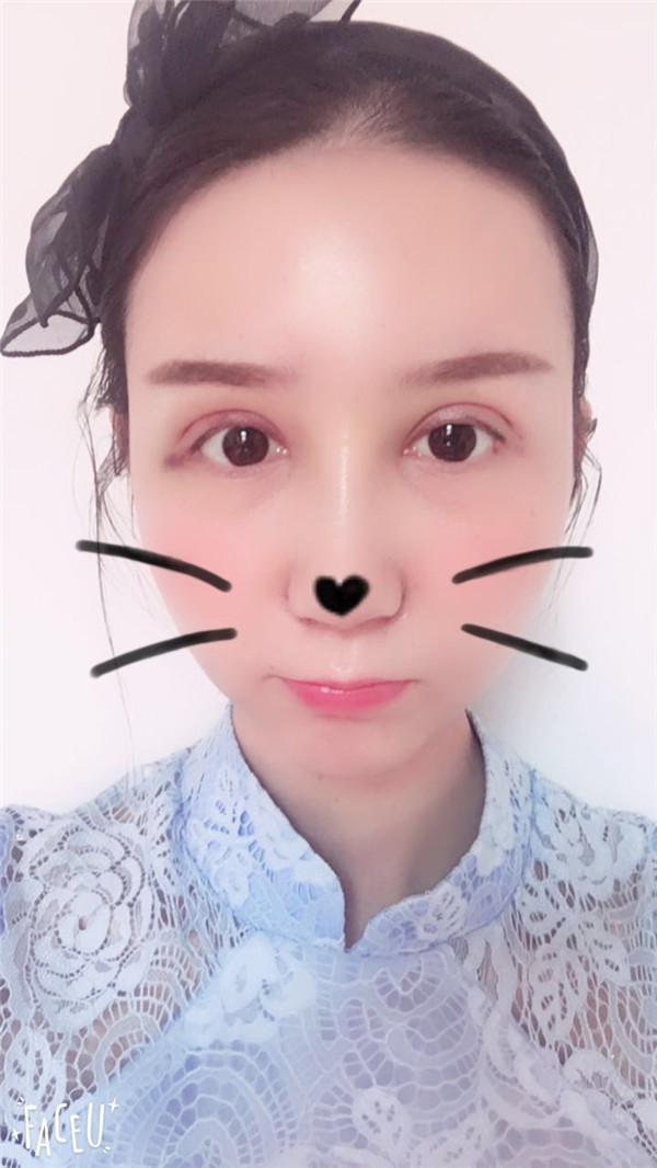 苏州紫馨眼部综合怎么样?价格案例