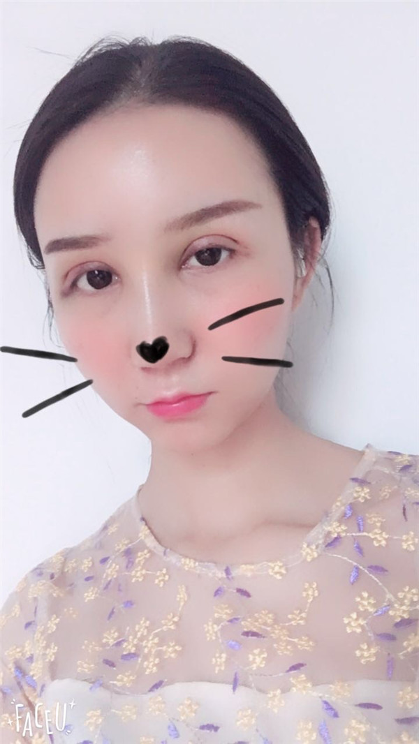 苏州紫馨眼部综合怎么样?价格案例