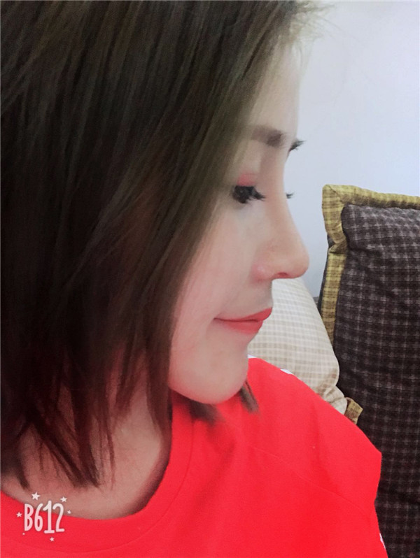 武汉美立方胡江伟体软骨垫鼻尖怎么样?价格案例