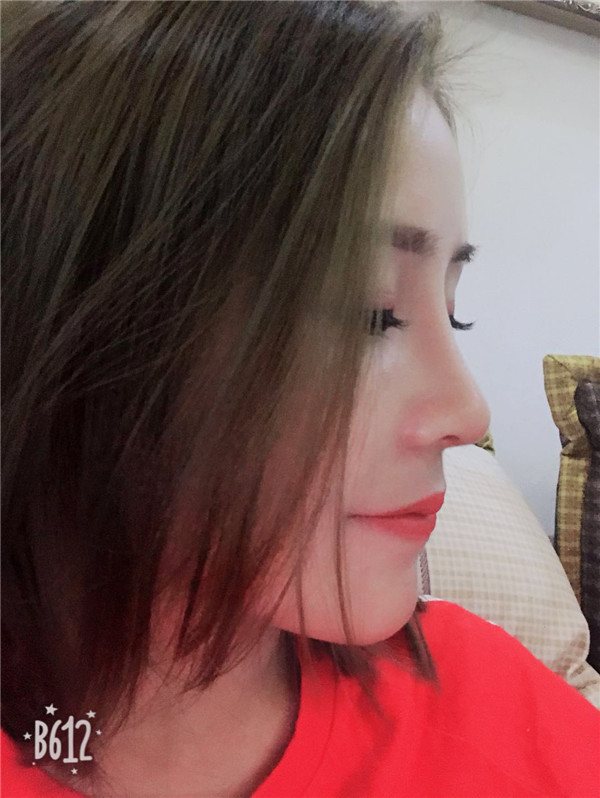 武汉美立方胡江伟体软骨垫鼻尖怎么样?价格案例
