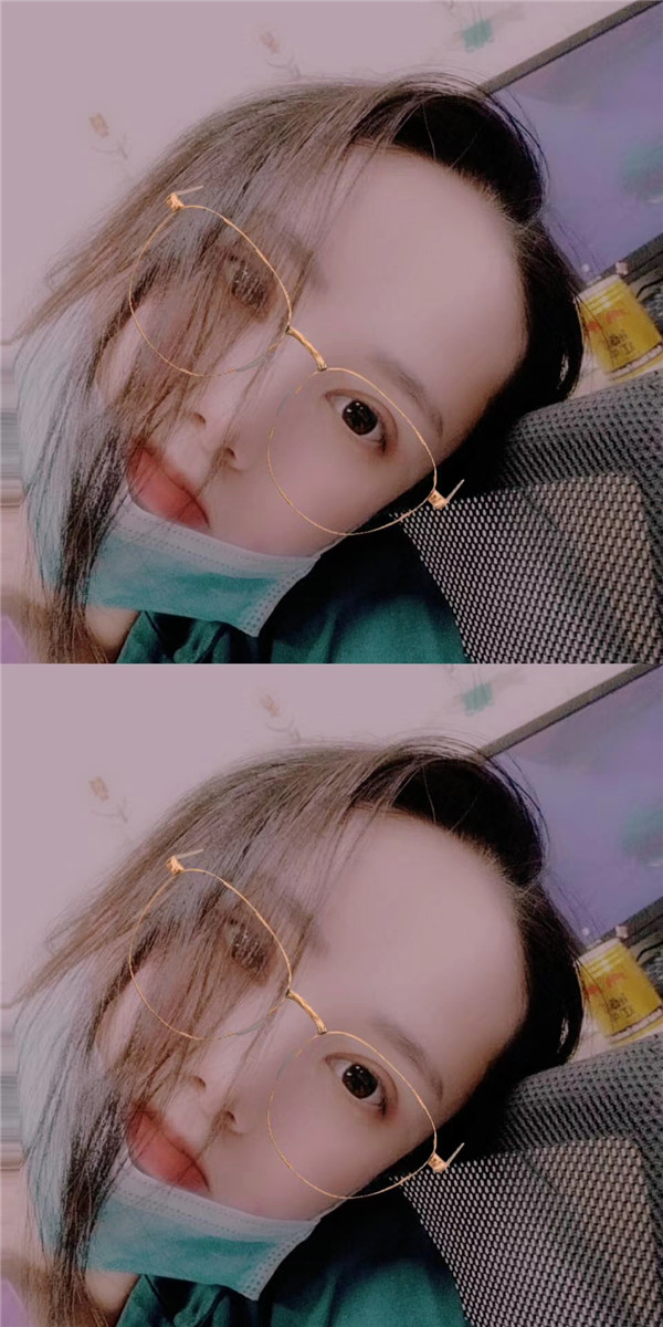 武汉韩辰吴辉眼整形怎么样?价格案例