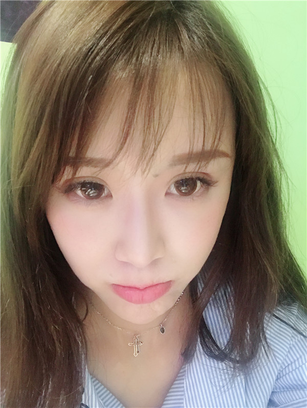 重庆艺星王方鹏双眼皮怎么样?价格案例