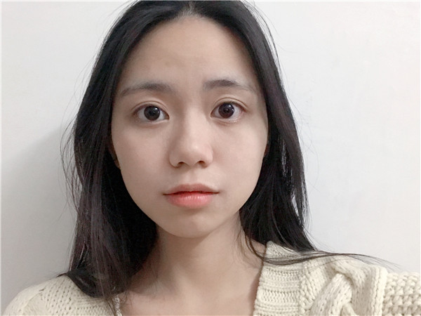 佛山市苏李秀英医院眼部整形怎么样?价格案例