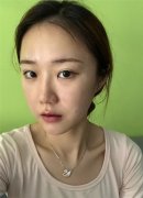 广州蒂伊王芳娇M唇手术怎么样？价格案例