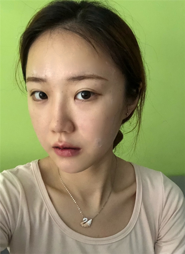 广州蒂伊王芳娇M唇手术怎么样?价格案例