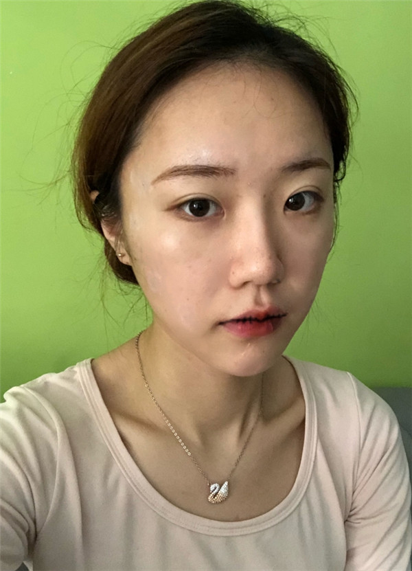 广州蒂伊王芳娇M唇手术怎么样?价格案例