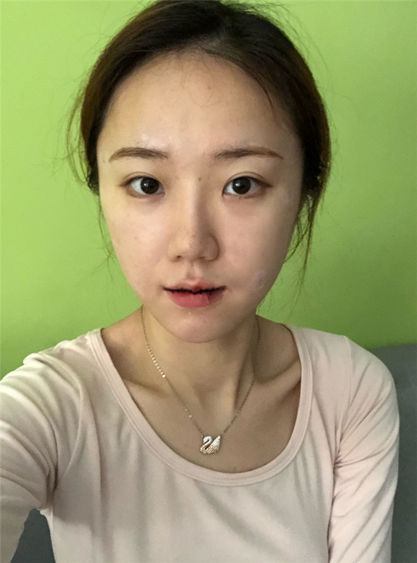 广州蒂伊王芳娇M唇手术怎么样?价格案例
