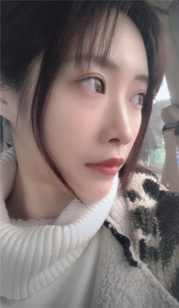 上海华美张朋脂肪丰额头怎么样?价格案例