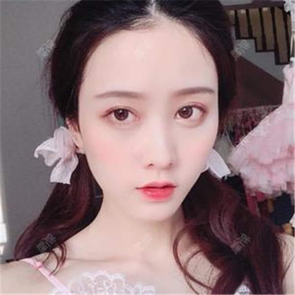 武汉汉秀医院吴明瑞眼部整形怎么样?价格案例