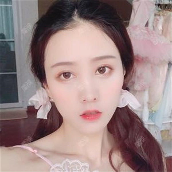 武汉汉秀医院吴明瑞眼部整形怎么样?价格案例