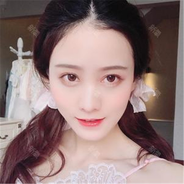 武汉汉秀医院吴明瑞眼部整形怎么样?价格案例