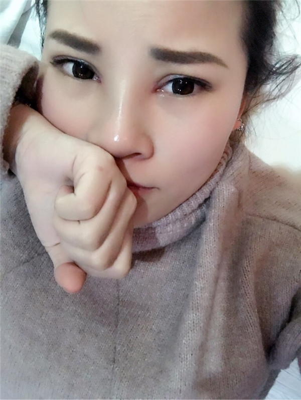 长春中妍王纳切开双眼皮怎么样?价格案例