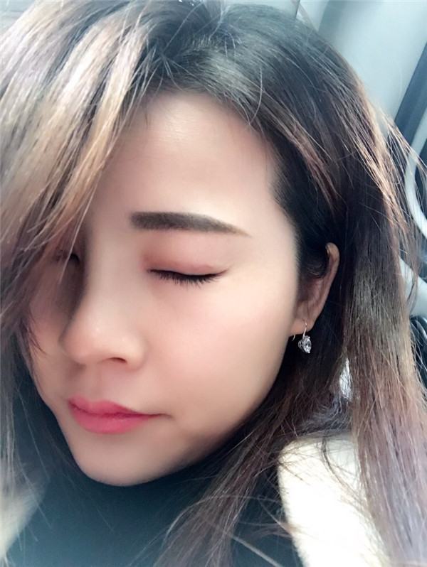 长春中妍王纳切开双眼皮怎么样?价格案例