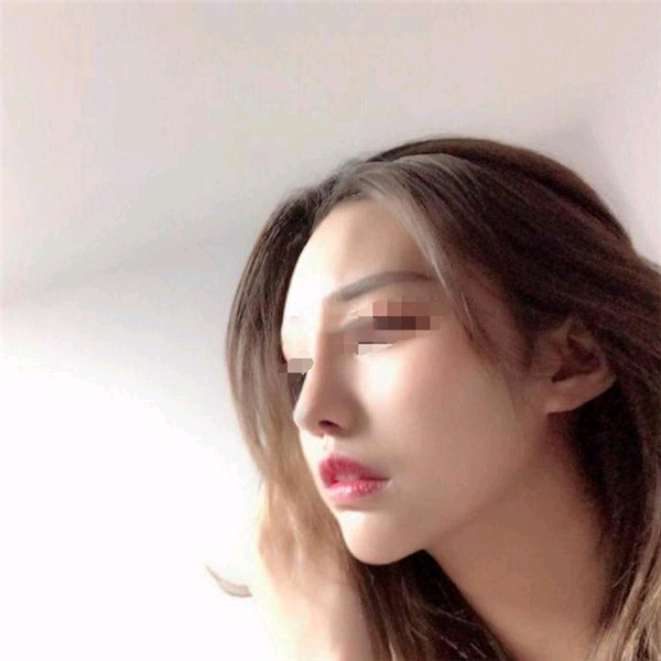 台州博雅美惠王大明隆鼻怎么样?价格案例
