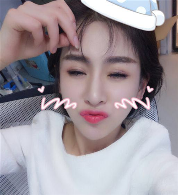 岛亚美妍安翔脂肪丰额头怎么样?价格案例