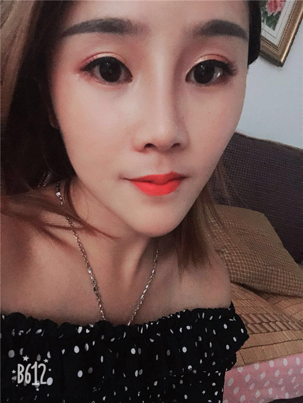 武汉美立方胡江伟软骨垫鼻尖怎么样?价格案例