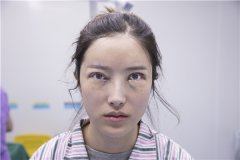 成都美上美罗通贵眼部修复怎么样？价格案例