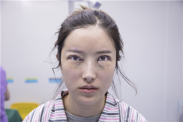 成都美上美罗通贵眼部修复怎么样?价格案例