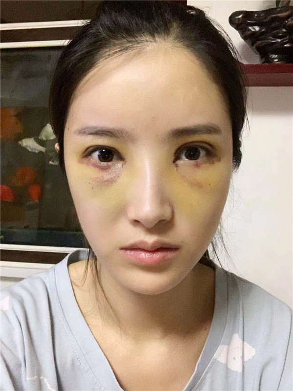 成都美上美罗通贵眼部修复怎么样?价格案例