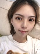 重庆曹阳丽格曹阳切开双眼皮怎么样？价格案例