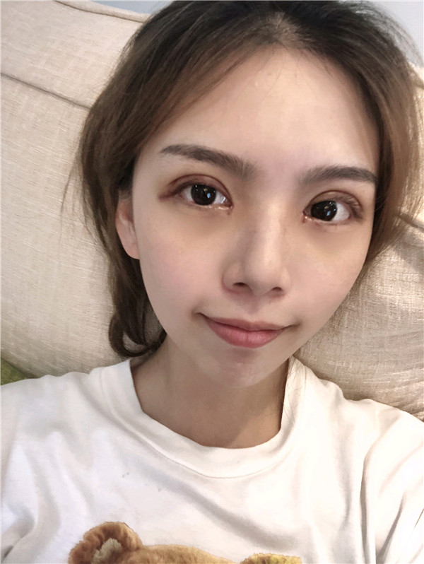 重庆曹阳丽格曹阳切开双眼皮怎么样?价格案例