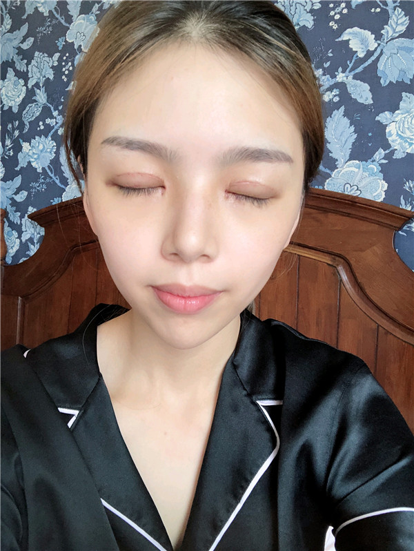 重庆曹阳丽格曹阳切开双眼皮怎么样?价格案例