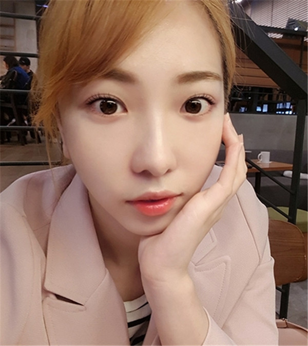 温州百佳东方整形孙华刚眼部手术怎么样?价格案例