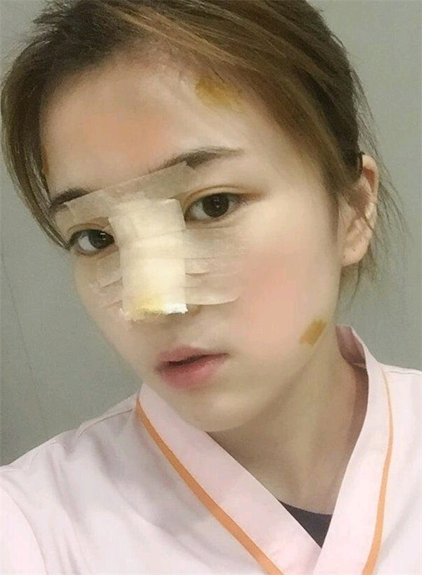 台州博雅美惠医疗王大明隆鼻怎么样?价格案例