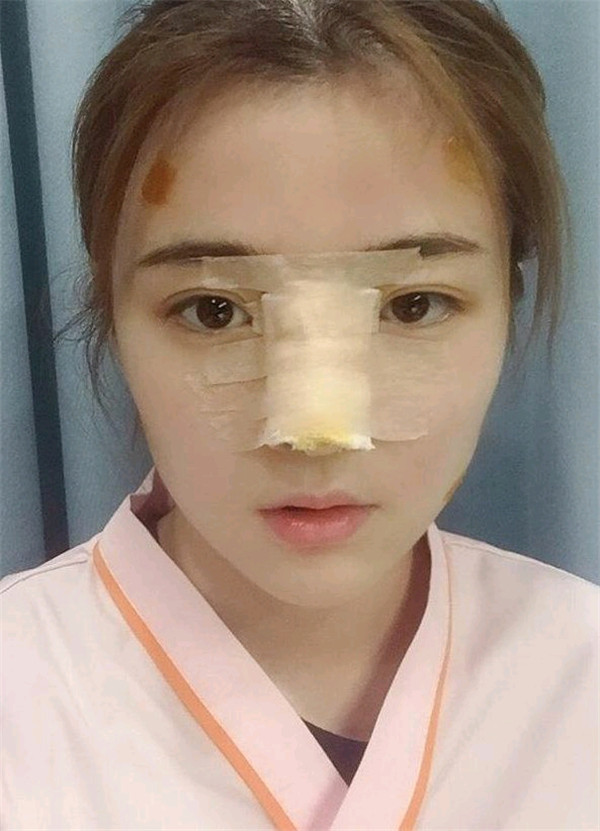 台州博雅美惠医疗王大明隆鼻怎么样?价格案例