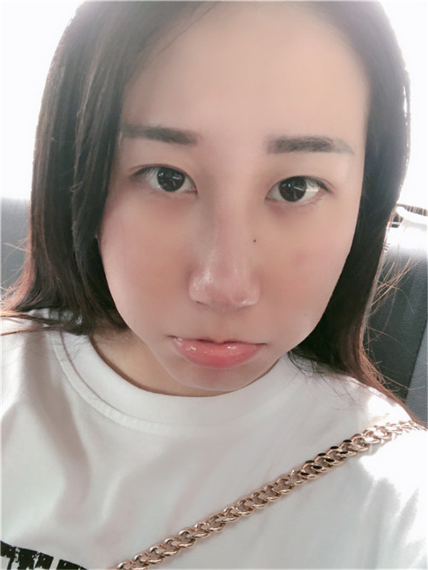 广州可玫尔鼻部手术怎么样?价格案例