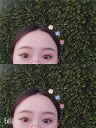 蚌埠美莱坞张迪双眼皮怎么样？价格案例