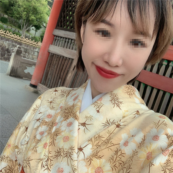南京缪斯女神范家鑫鼻部手术怎么样?价格案例
