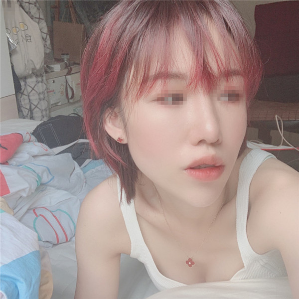 南京缪斯女神范家鑫鼻部手术怎么样?价格案例