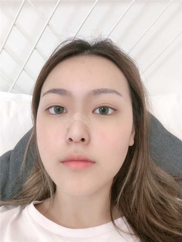 南京容丽妍医院王洛生鼻部手术怎么样?价格案例