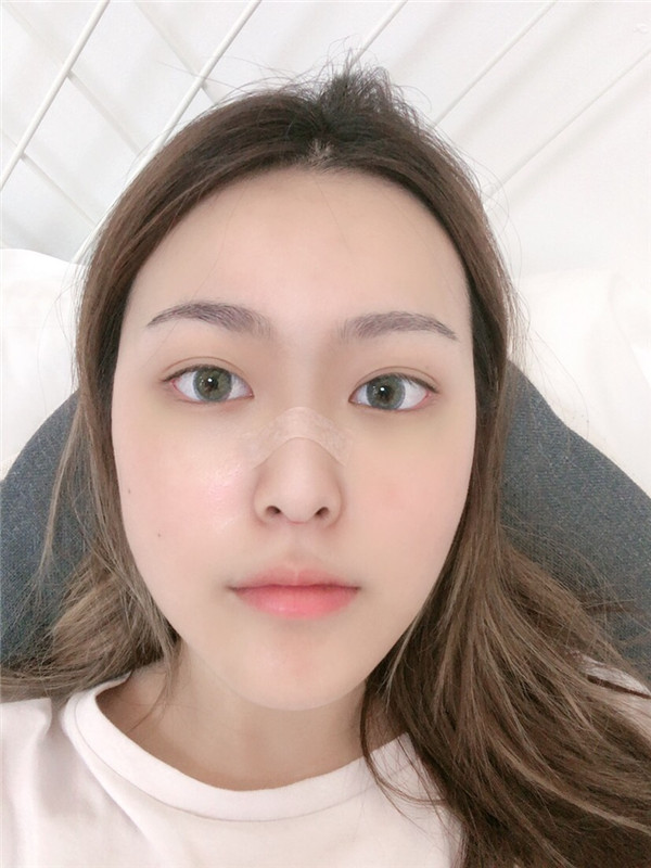 南京容丽妍医院王洛生鼻部手术怎么样?价格案例