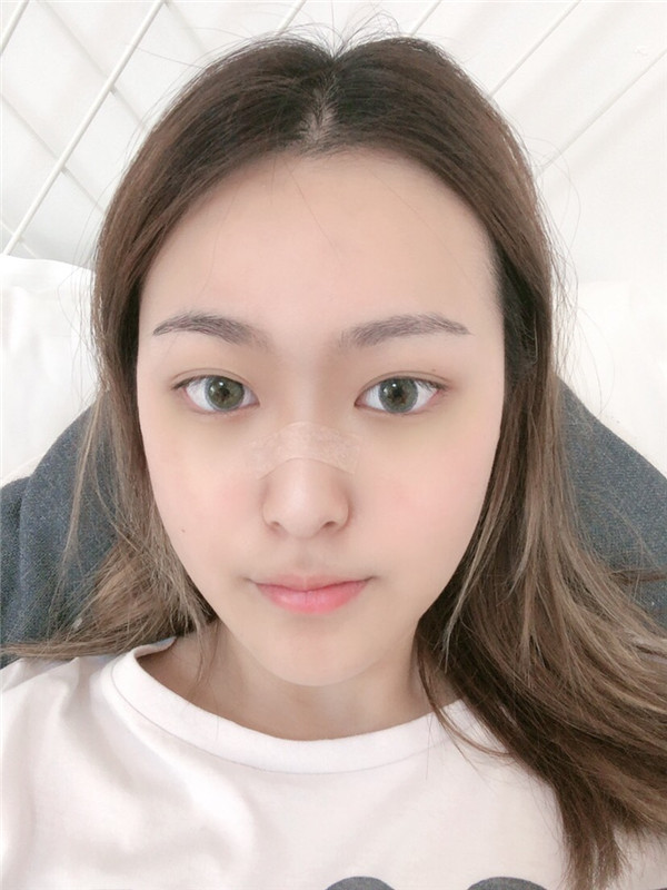 南京容丽妍医院王洛生鼻部手术怎么样?价格案例