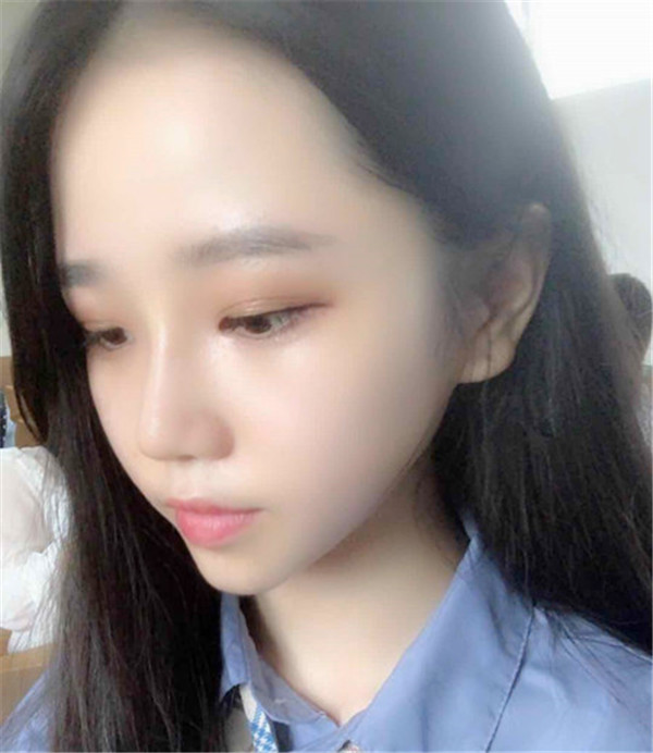 武汉媄妲医疗郑竞帆鼻部手术怎么样?价格案例