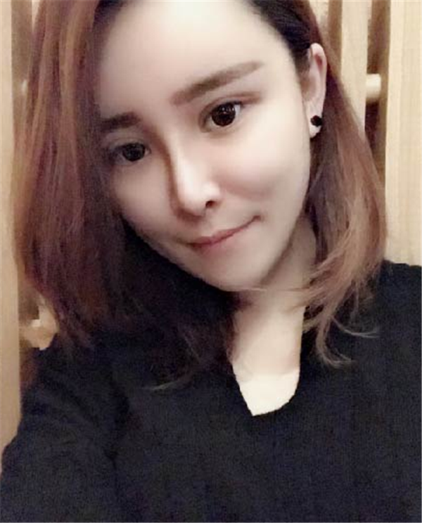 大连光普医美刘大伟鼻部手术怎么样?价格案例