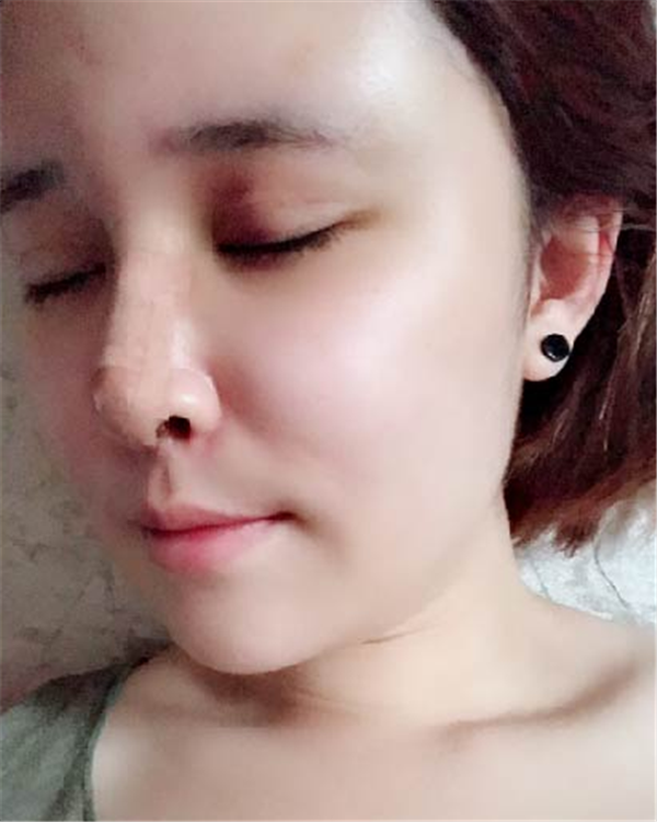 大连光普医美刘大伟鼻部手术怎么样?价格案例