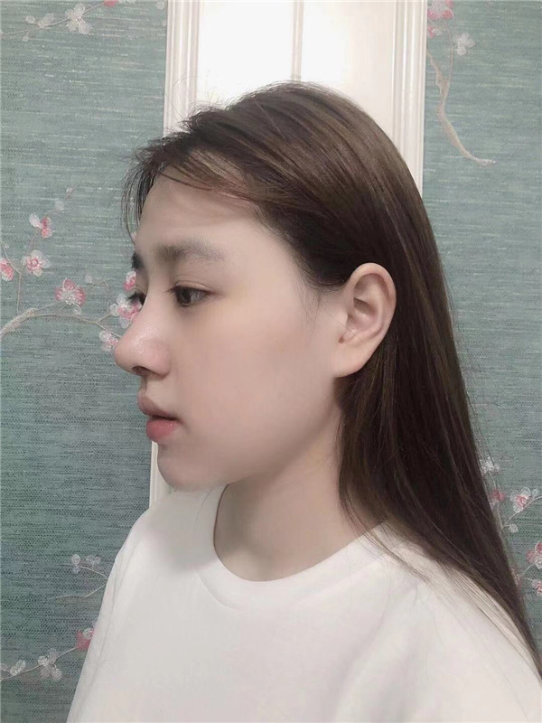 深圳颜美医美覃永喜隆鼻怎么样?价格案例