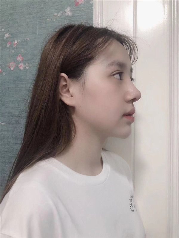 深圳颜美医美覃永喜隆鼻怎么样?价格案例