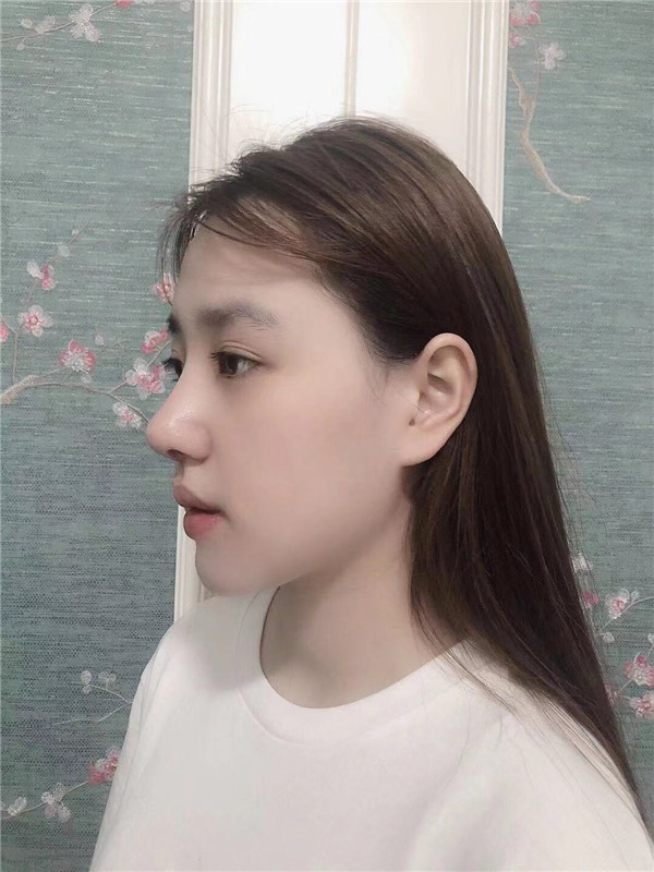 深圳颜美医美覃永喜隆鼻怎么样?价格案例