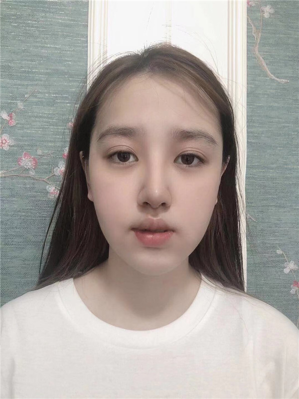 深圳颜美医美覃永喜隆鼻怎么样?价格案例