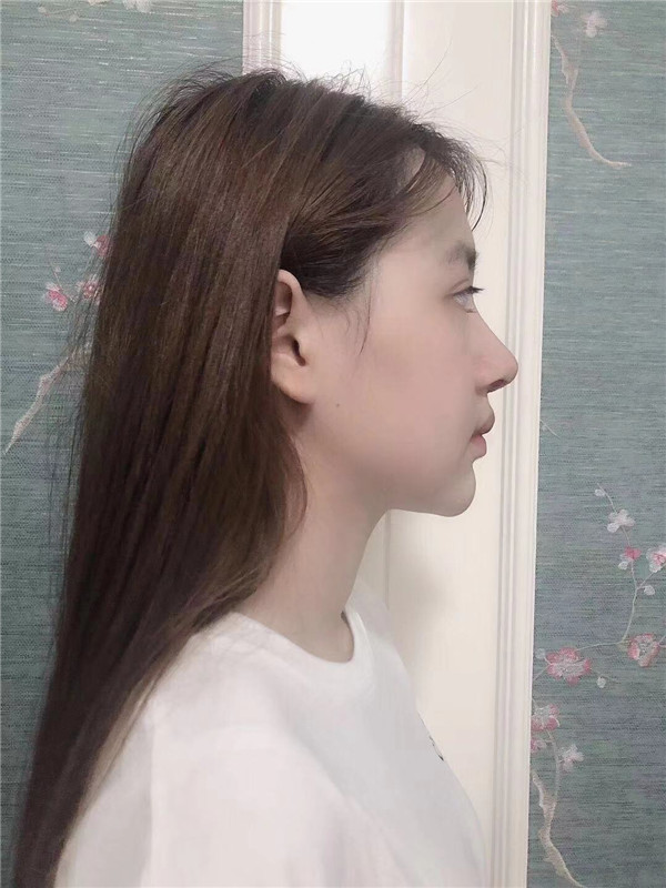 深圳颜美医美覃永喜隆鼻怎么样?价格案例