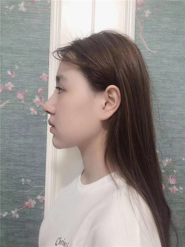 深圳颜美医美覃永喜隆鼻怎么样?价格案例