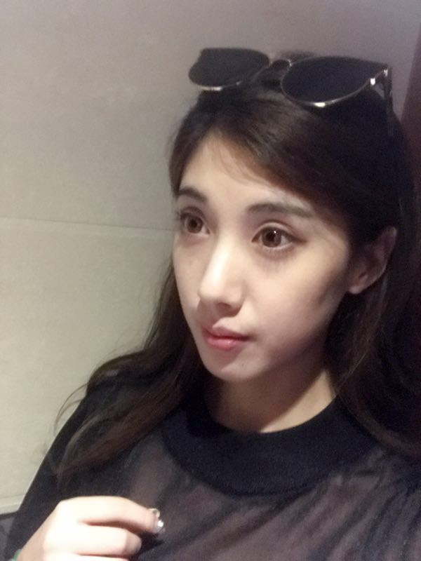 长春中妍硅胶隆鼻怎么样?价格案例