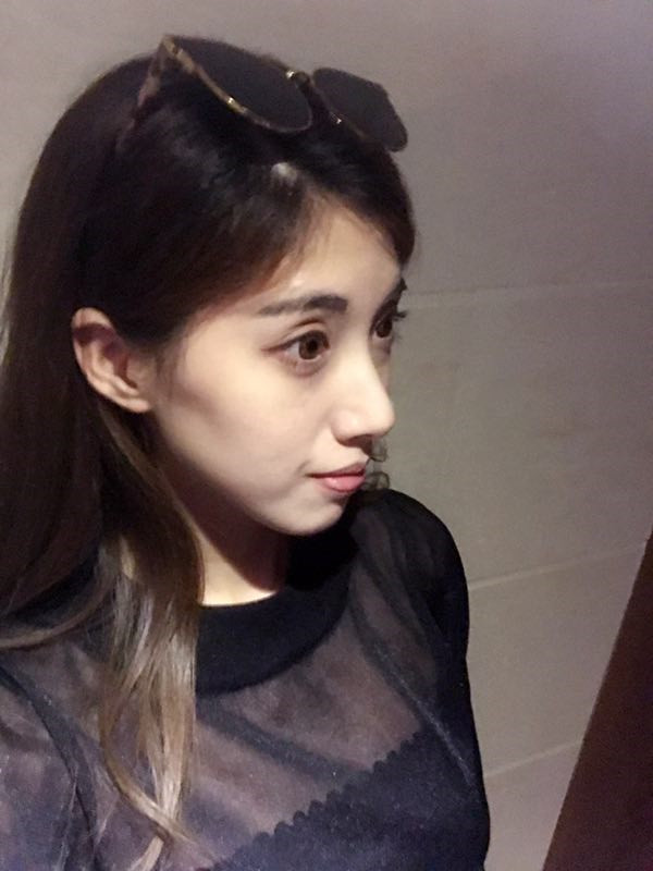 长春中妍硅胶隆鼻怎么样?价格案例
