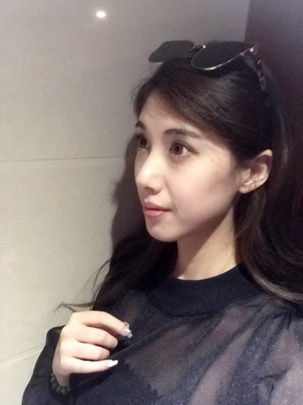 长春中妍硅胶隆鼻怎么样?价格案例